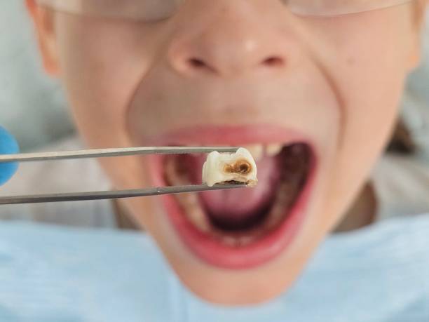 Best Chipped Tooth Repair Near Me  in Glen Carbon, IL